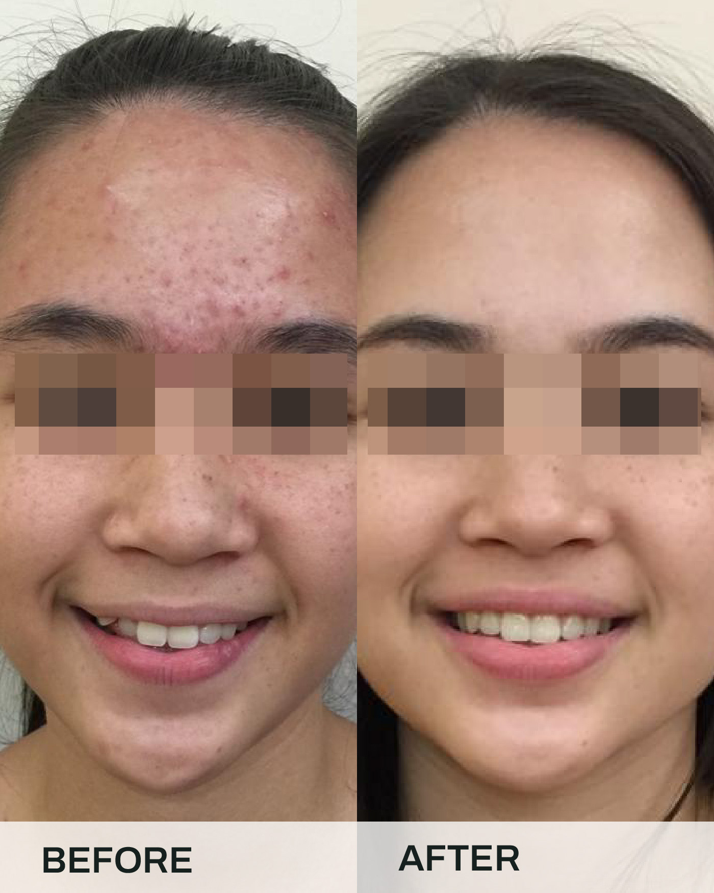 Before and after braces treatment, case 3, at iCare Dental IOI City Mall Putrajaya