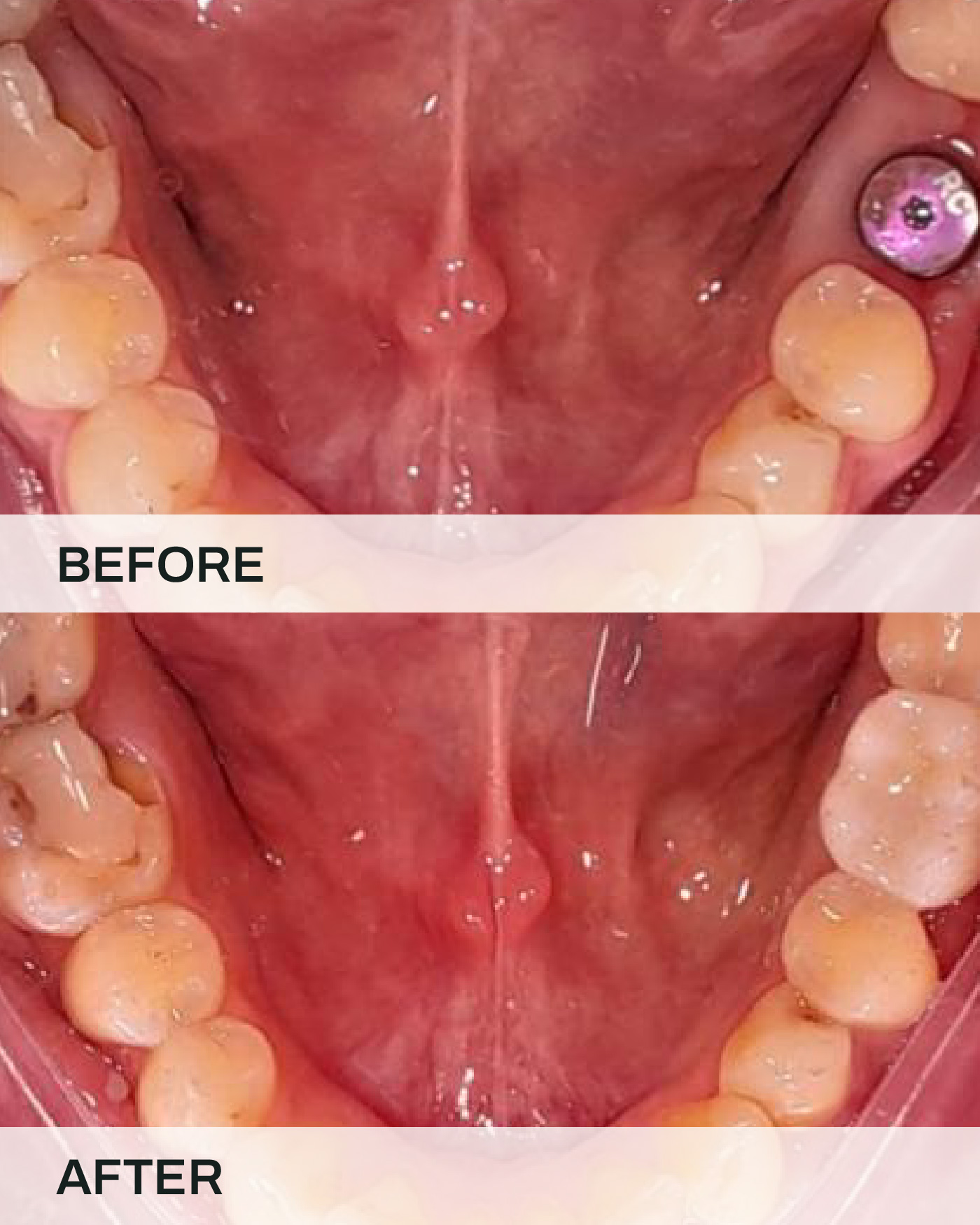 Dental implants