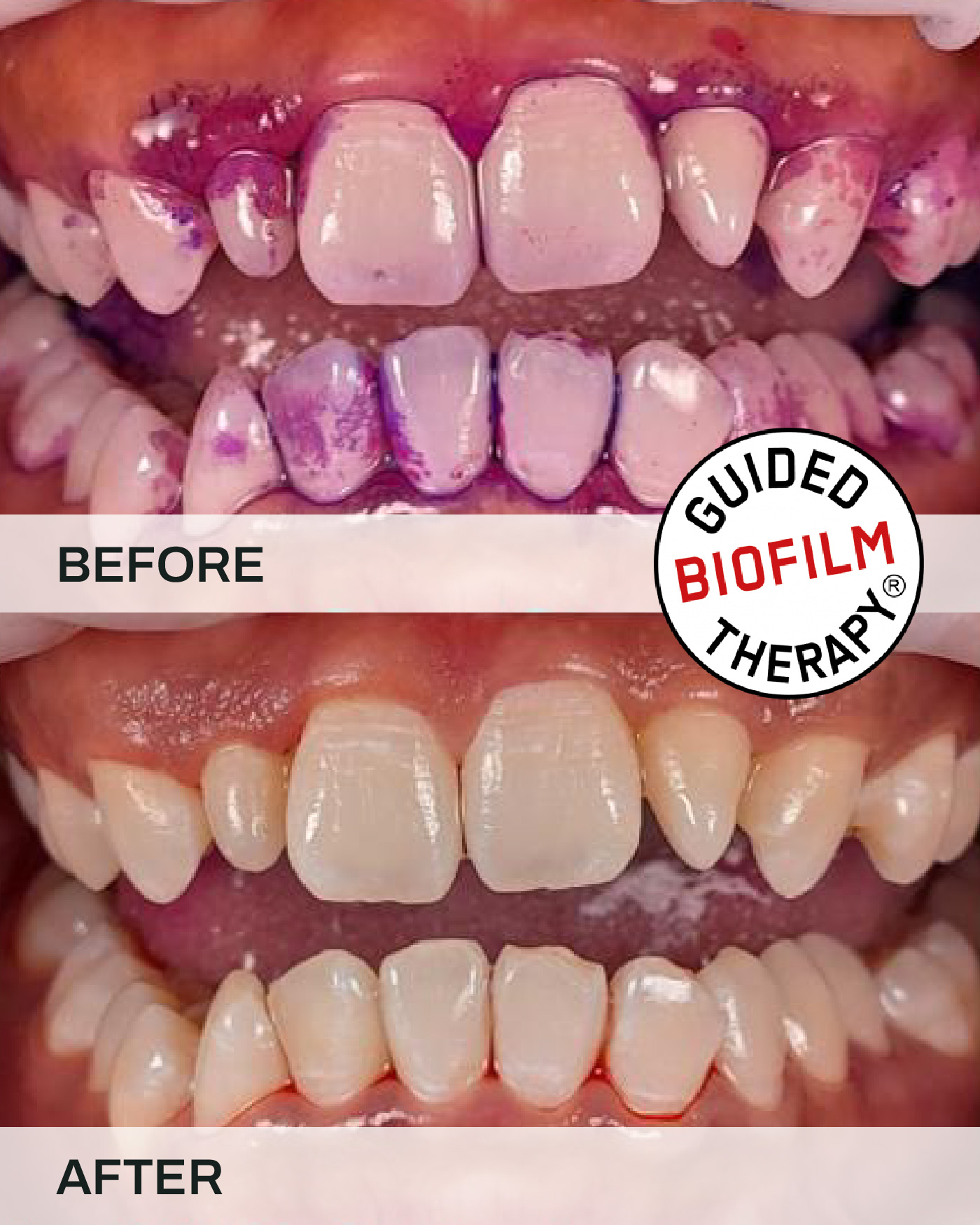 Guided Biofilm Therapy