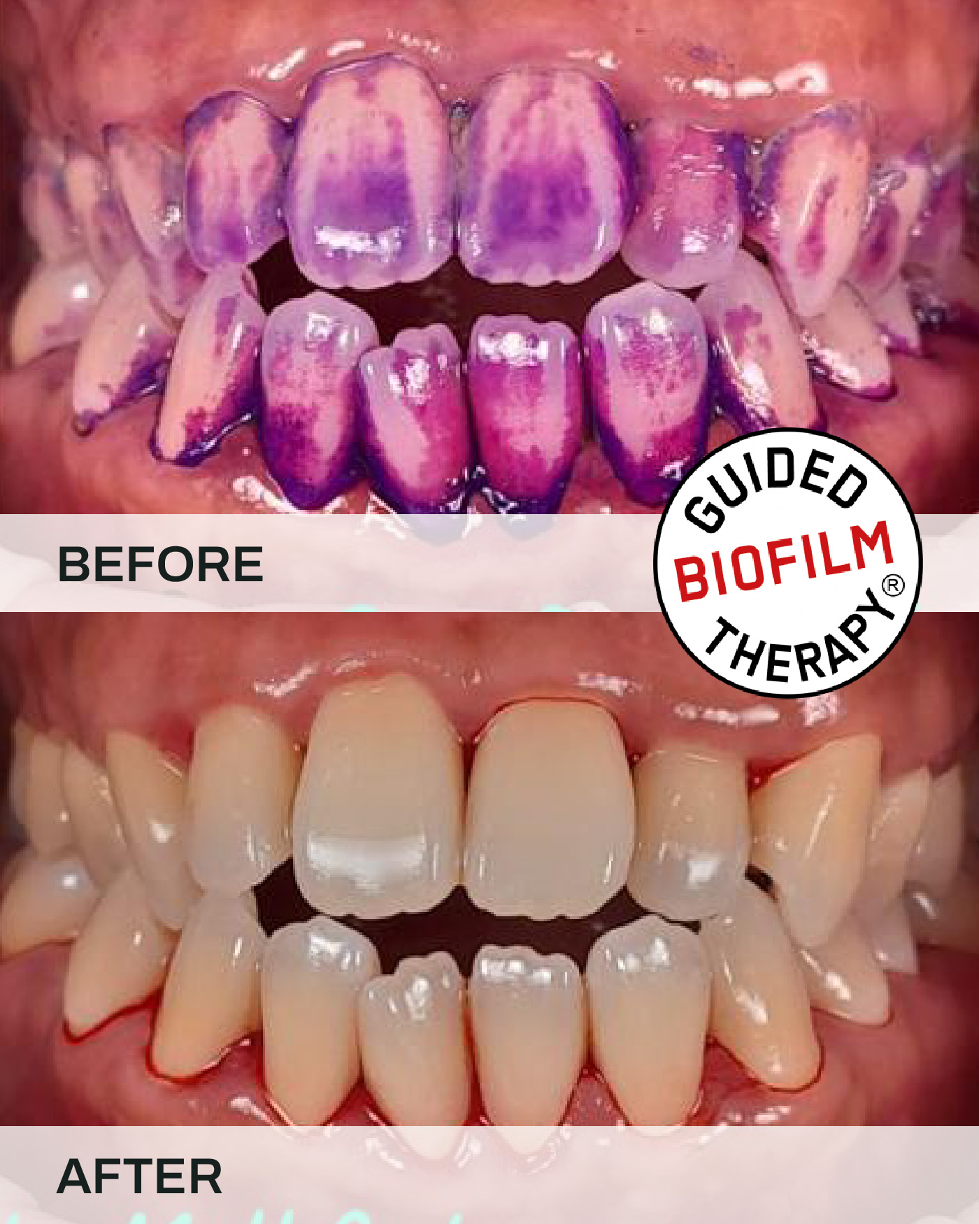 Before and after teeth scaling and cleaning, case 3, at iCare Dental IOI City Mall Putrajaya