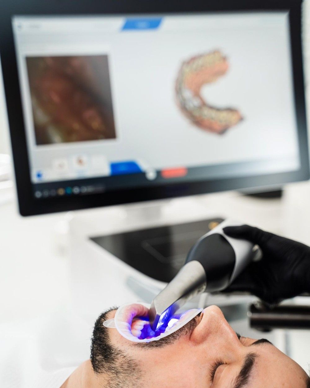 Patient having a 3D digital scan taken with an intraoral scanner at iCare Dental IOI City Mall Putrajaya