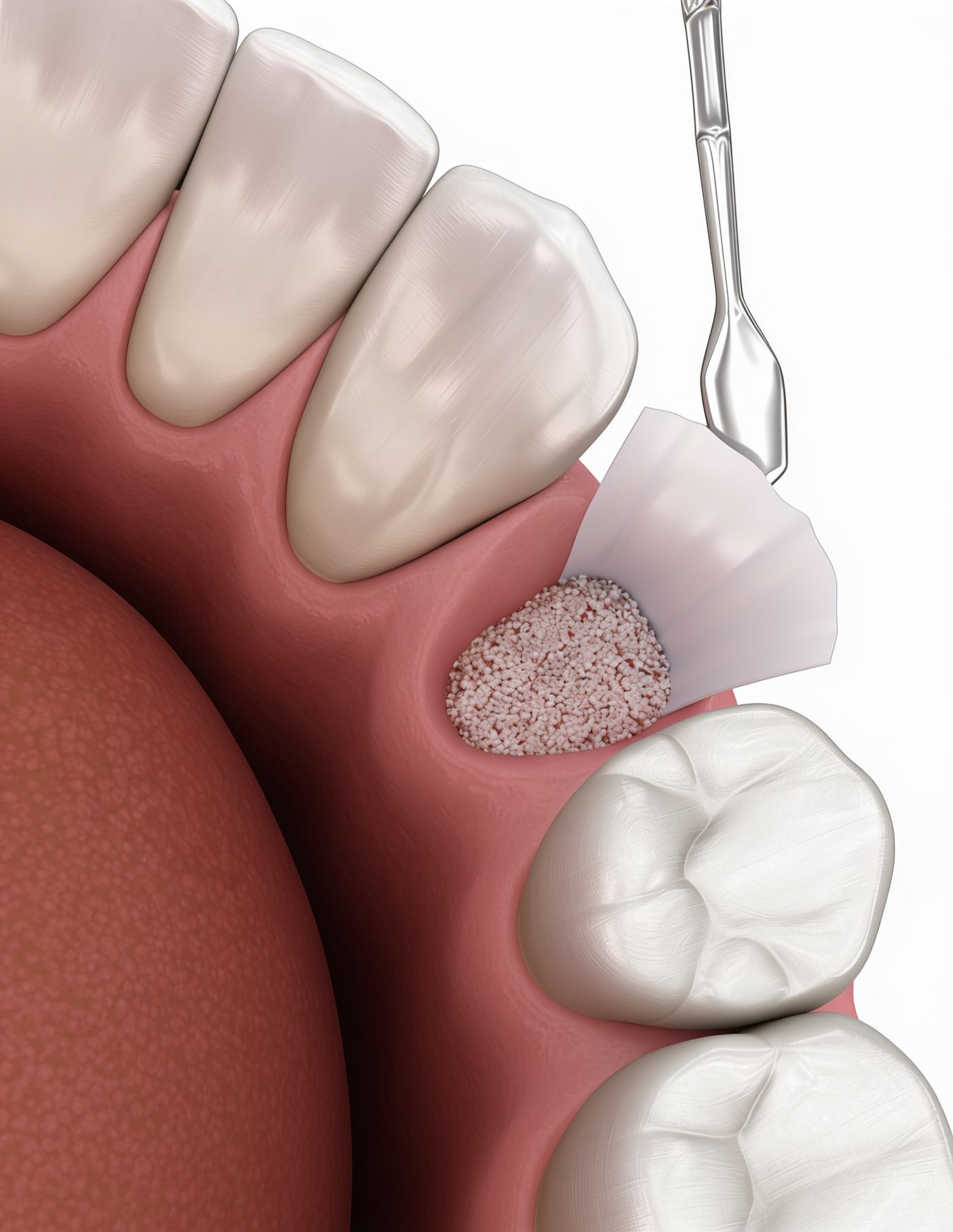 3D illustration of bone graft material placed in the jaw beneath a protective membrane at iCare Dental IOI City Mall Putrajaya