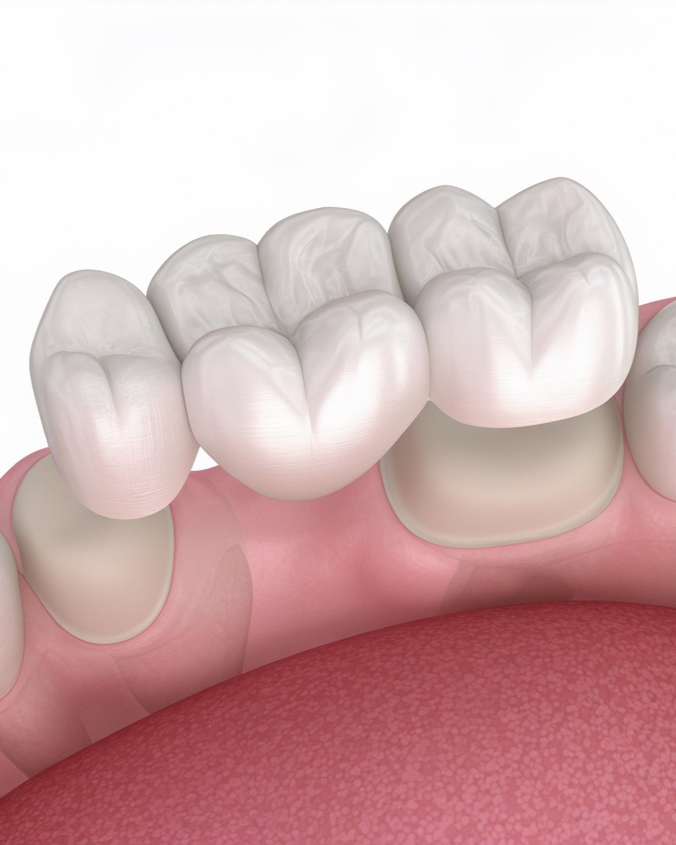 3D illustration of a fixed dental bridge anchored onto the supporting teeth at iCare Dental IOI City Mall Putrajaya