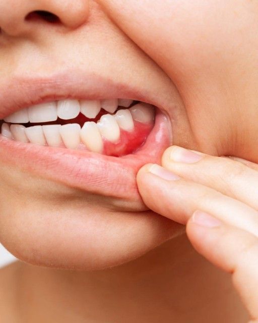 Gum Disease Treatment