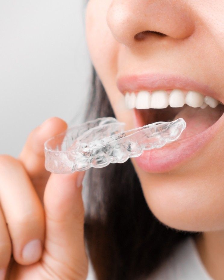 Close-up of a patient placing a clear custom retainer over her teeth at iCare Dental IOI City Mall Putrajaya