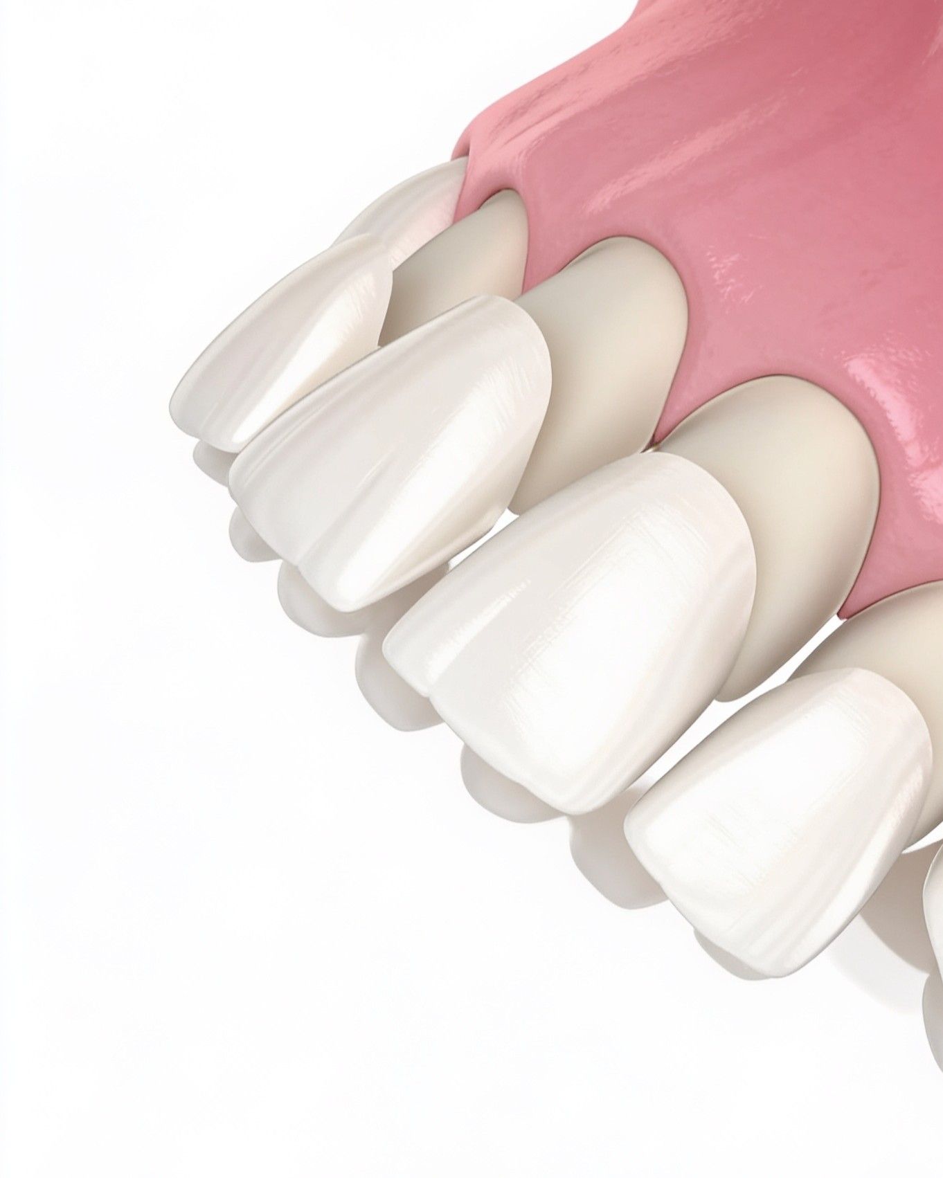 Veneers