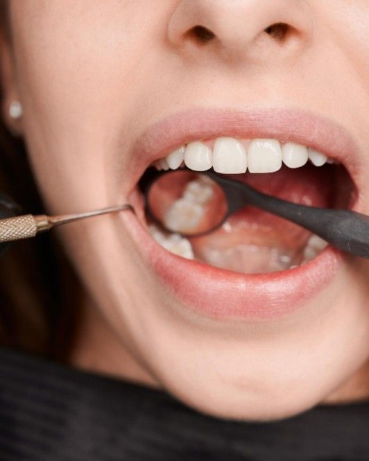 Dentist examining a patient's wisdom teeth with a mouth mirror at iCare Dental IOI City Mall Putrajaya